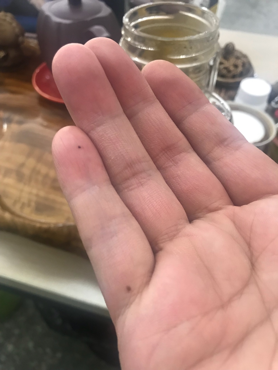 小手指莫名其妙长了一颗黑痣,这是色素沉淀吗?